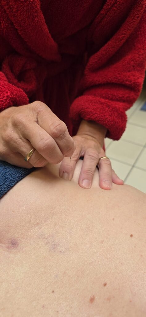 dry needling